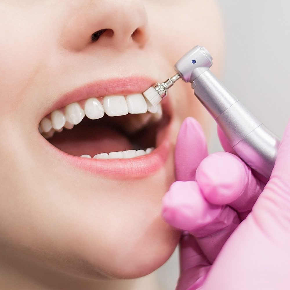 dentist-brushes-teeth-young-girl-teeth-whitening-2022-05-21-19-17-16-utc