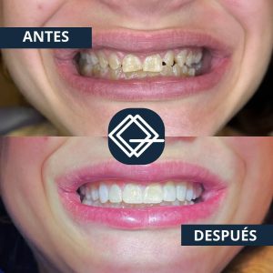 diseño-sonrisa-fuenlabrada (1)