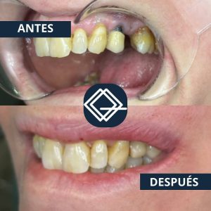diseño-sonrisa-fuenlabrada (10)