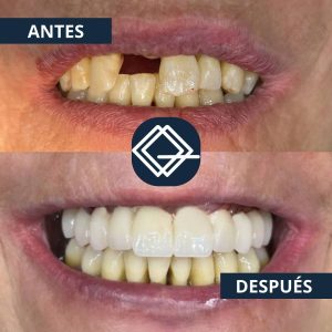 diseño-sonrisa-fuenlabrada (13)