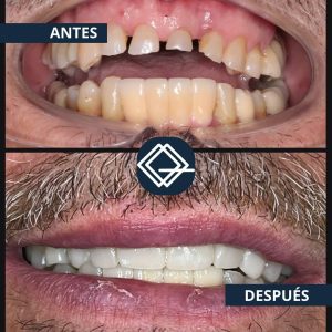 diseño-sonrisa-fuenlabrada (14)