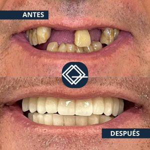 diseño-sonrisa-fuenlabrada (15)