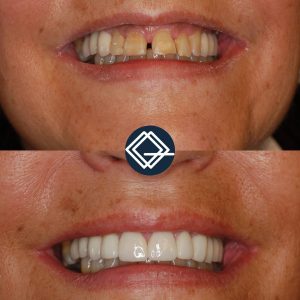 diseño-sonrisa-fuenlabrada (2)